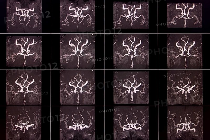 Black and white MRI images of a human brain showing the arteries in different layers, organised in a matrix