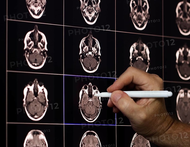 A hand points with a pen to MRI scans of brains displayed on a screen
