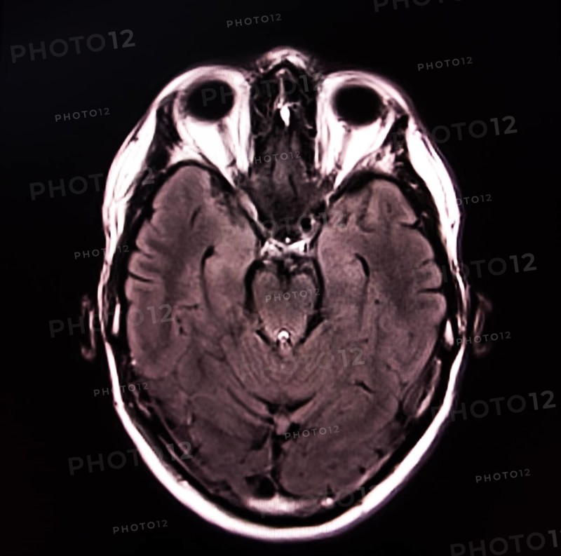 Black and white image of an MRI scan of a brain, showing detailed brain structure