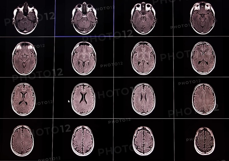 Several MRI scans of brain cross-sections shown in black and white on a black background