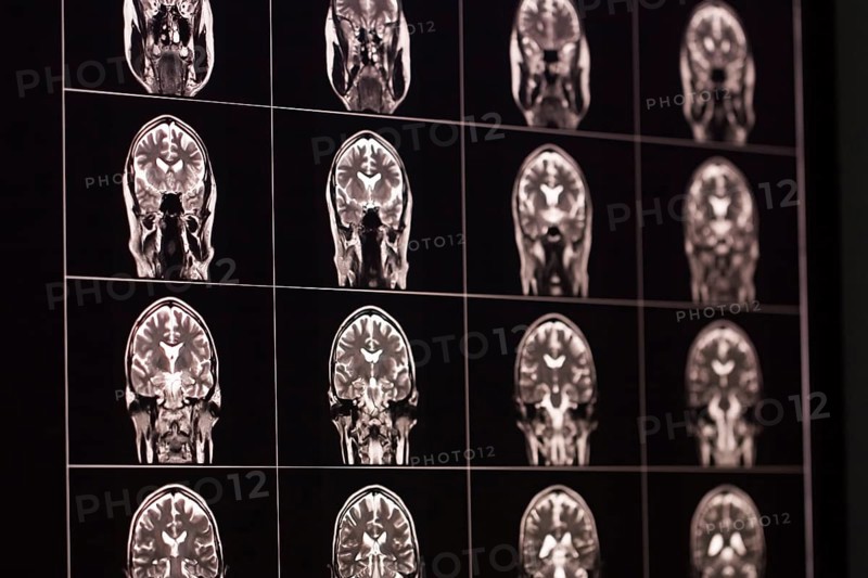 MRI scans of a brain in black and white, organised in a matrix, show different sections