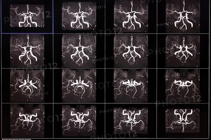 Several MRI images show the arteries of the brain in black and white with detailed neuronal structures