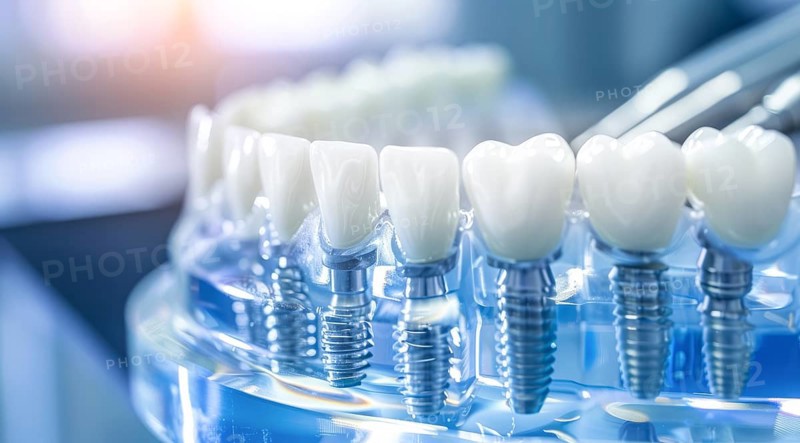 A close up of a titanium modern dental implant teeth with a silver implant screw, AI generated