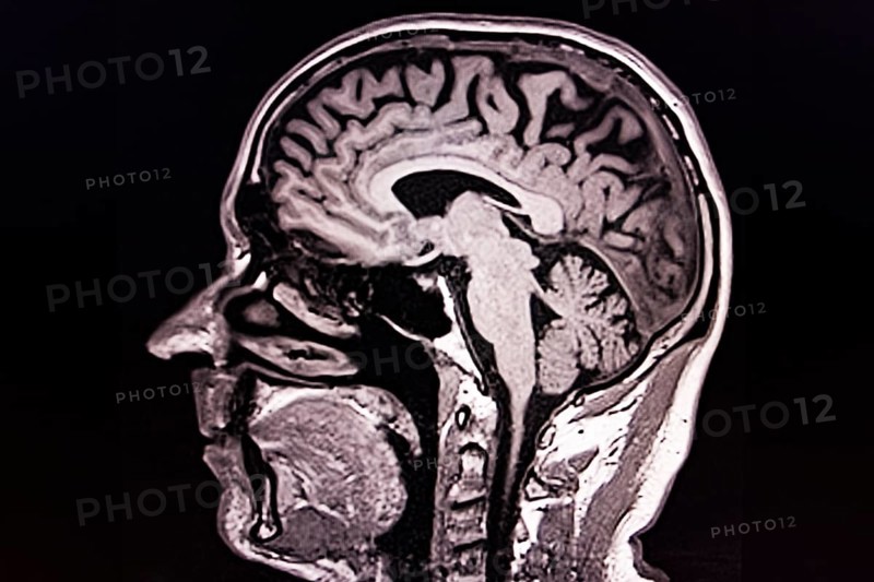Lateral black and white MRI scan of a human brain and skull