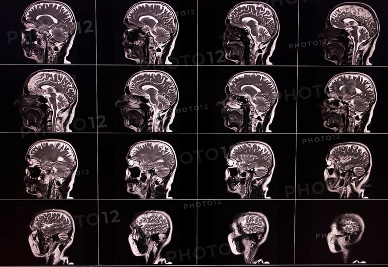 Several lateral MRI images of a brain showing different layers and details