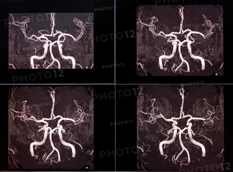 MRI X-ray image of brain arteries showing complex blood vessels in black and white