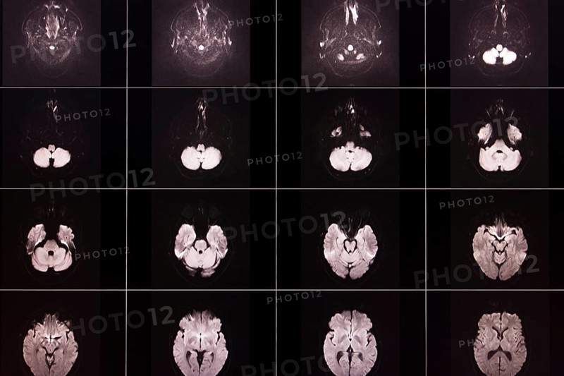 Several black and white MRI scans of a brain in different layers and angles, organised in a matrix