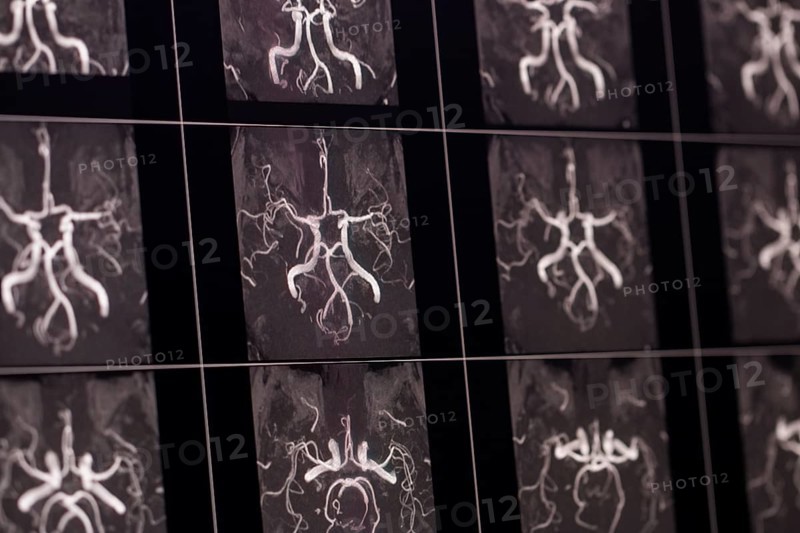 X-ray images of cerebral arteries and vessels of a human head, shown in black and white contrasts