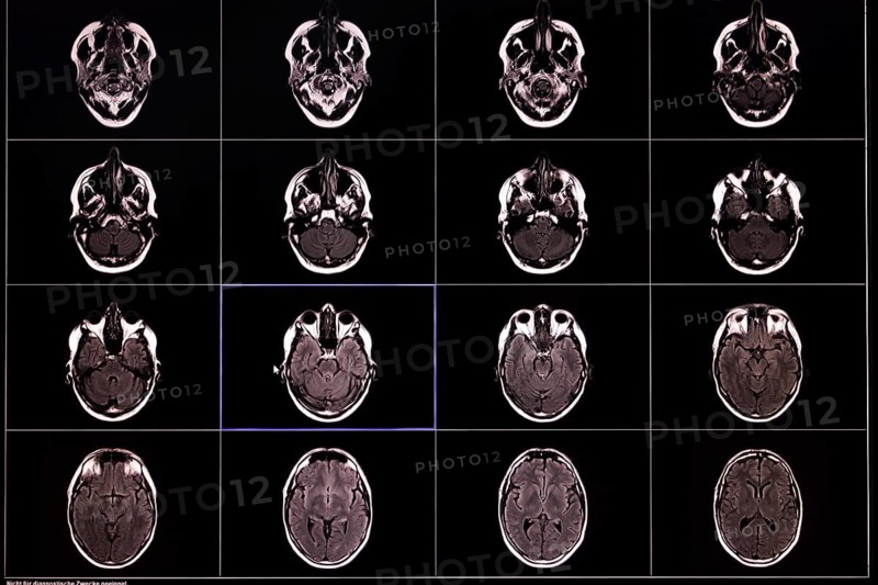 Black and white images of an MRI scan of the brain in several sectional planes