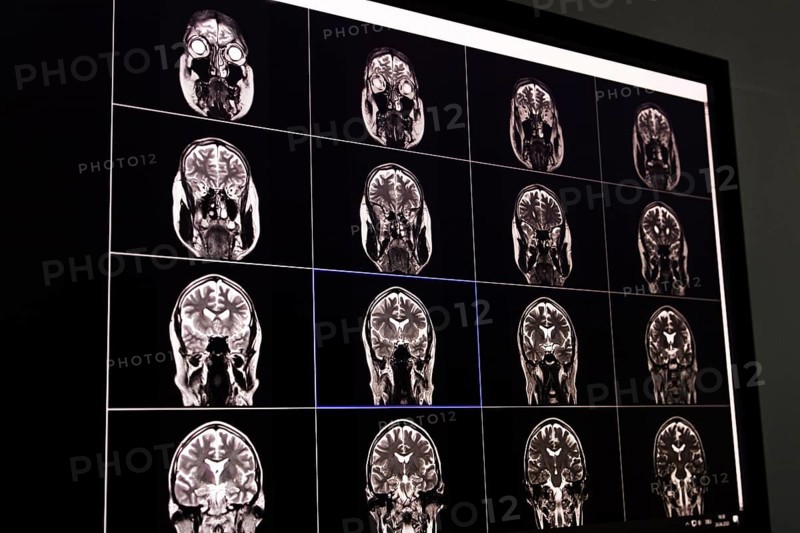 Black and white image of an MRI scan of the brain displayed on a screen