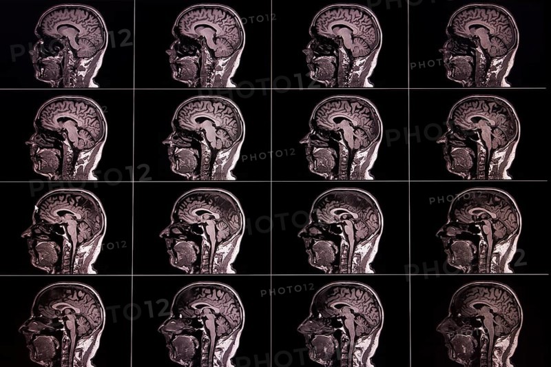 Several lateral MRI images of a brain, displayed in a matrix, show different layers