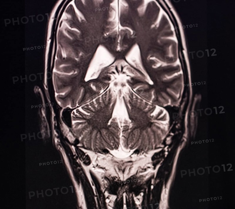 Black and white MRI image of the human brain showing detailed structural information