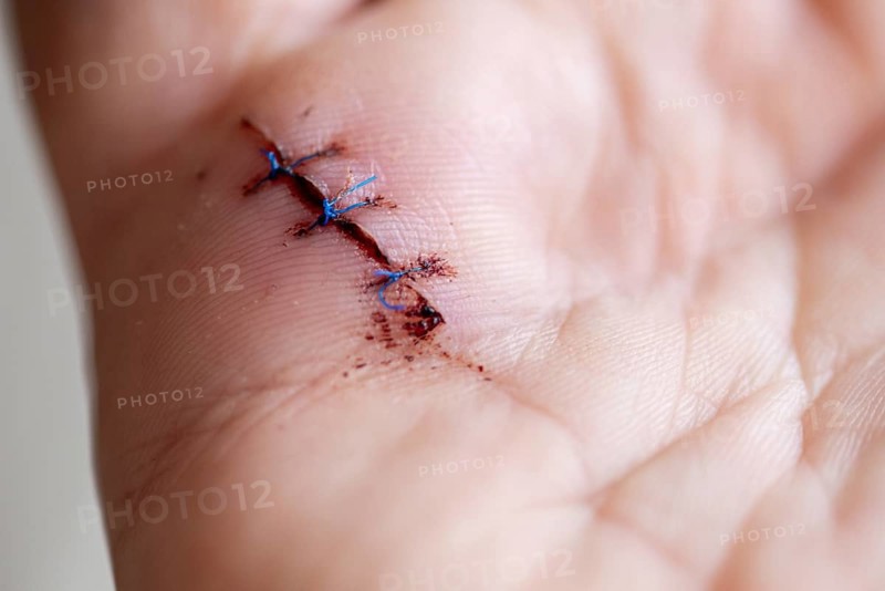 Operated snap finger, wound closed with three stitches, snap finger is the result of tendinitis of the hand, thickening of the tendon disrupts the movement of the finger, can be repaired by surgery, Germany, Europe