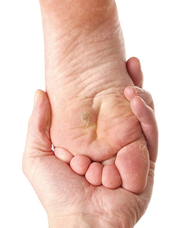 Dermatologist examining a foot for callus and dry skin, towards white