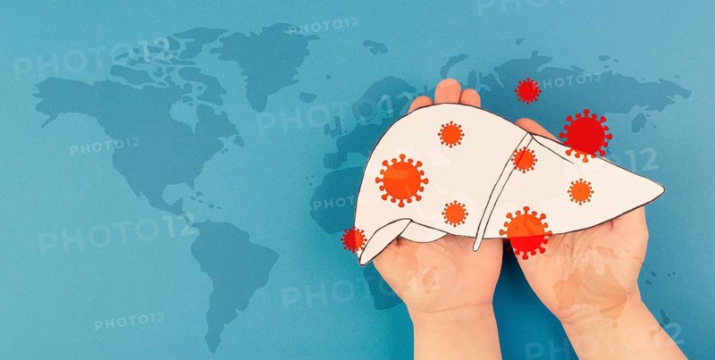 Liver organ infected with virus, world hepatitis day, diagnosis of cancer, cirrhosis health issue, alcoholic fatty liver