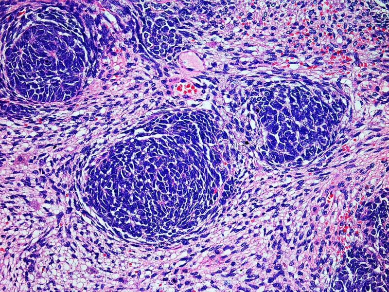 Microscopic Image of a Wilms Tumor or Nephroblastoma of a childs kidney viewed at 200x magnification with hematoxylin and eosin staining one of the most common cancers affecting children