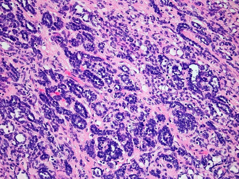 Wilms Tumor or Nephroblastoma of a childs kidney viewed at 200x magnification with hematoxylin and eosin staining one of the most common cancers affecting children
