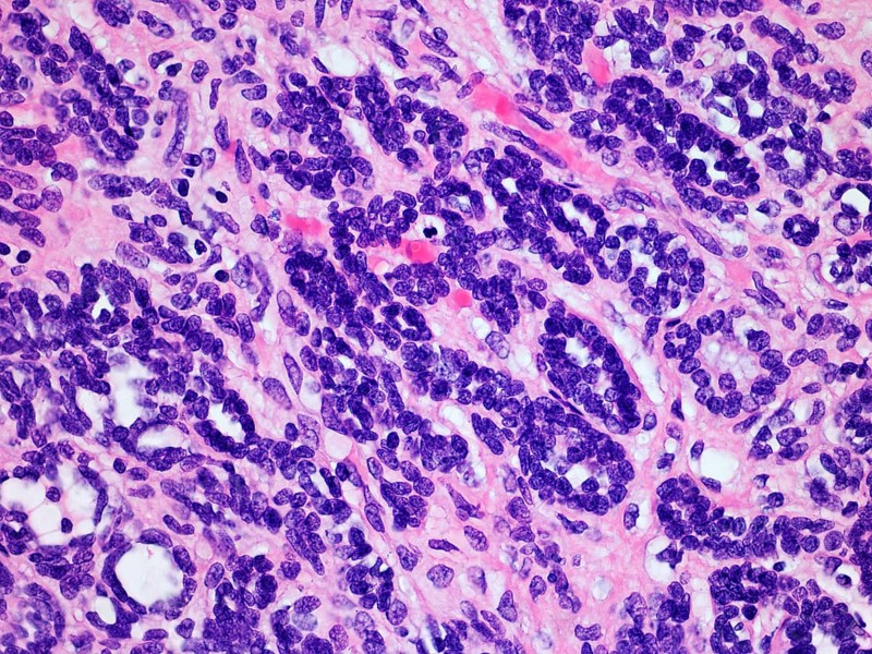 Microscopic image of a Wilms Tumor or Nephroblastoma of a childs kKidney viewed at 400x magnification with hematoxylin and eosin staining one of the most common cancers affecting children