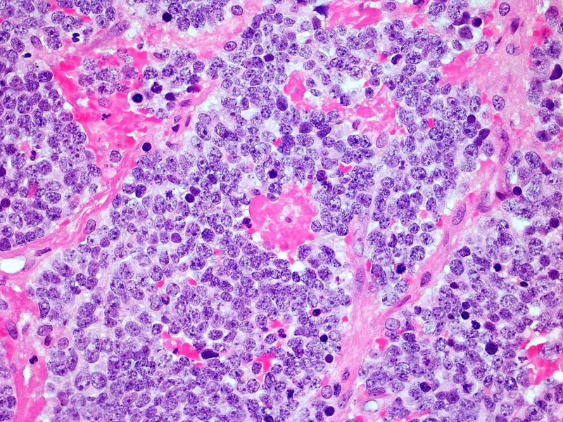 Microscopic image of a Neuroblastoma malignant tumor of the adrenal gland viewed at 300x magnification with haemotoxylin and eosin staining one of the most common cancers affecting children
