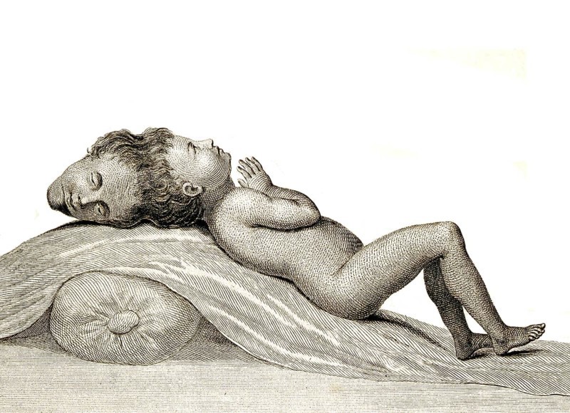 A child with two heads joined at the apex, Siamese twins, Double malformation, a maldevelopment in which identical twins remain physically joined to each other during the course of their intrauterine development and after birth, Historical, digitally restored reproduction from an original of the period