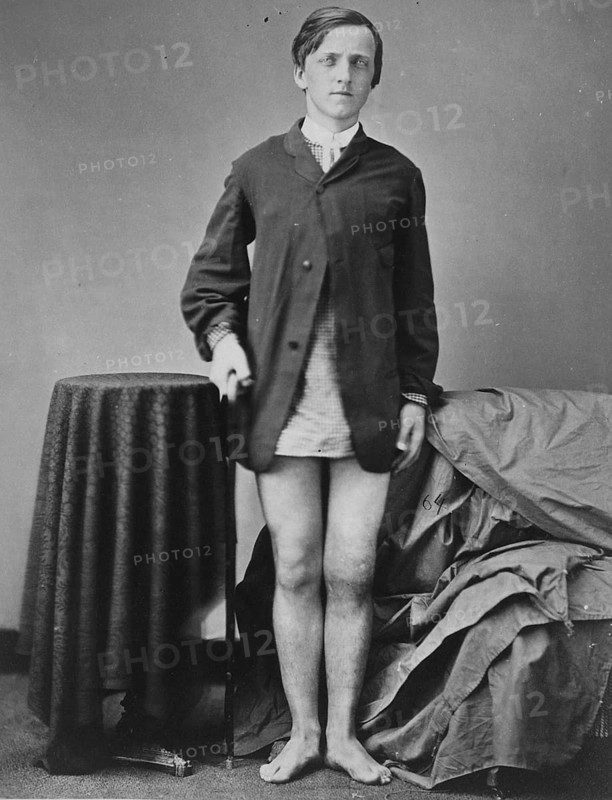 War-wounded Private G. W. Warrington, recovering without amputation after gunshot fracture of the right kneecap, from the Surgical Department photo catalogue, 1880, photo by William Bell, Historic, digitally restored reproduction from an original of the period