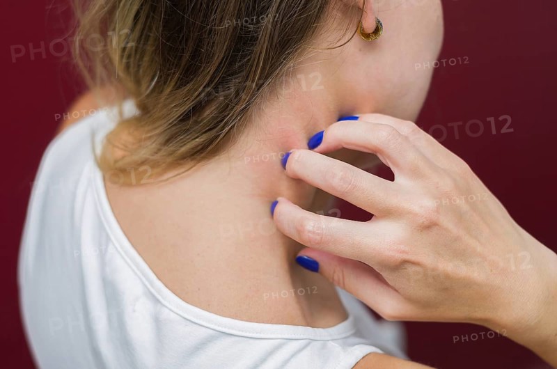 Great concept of allergy and skin diseases, young woman scratching herself