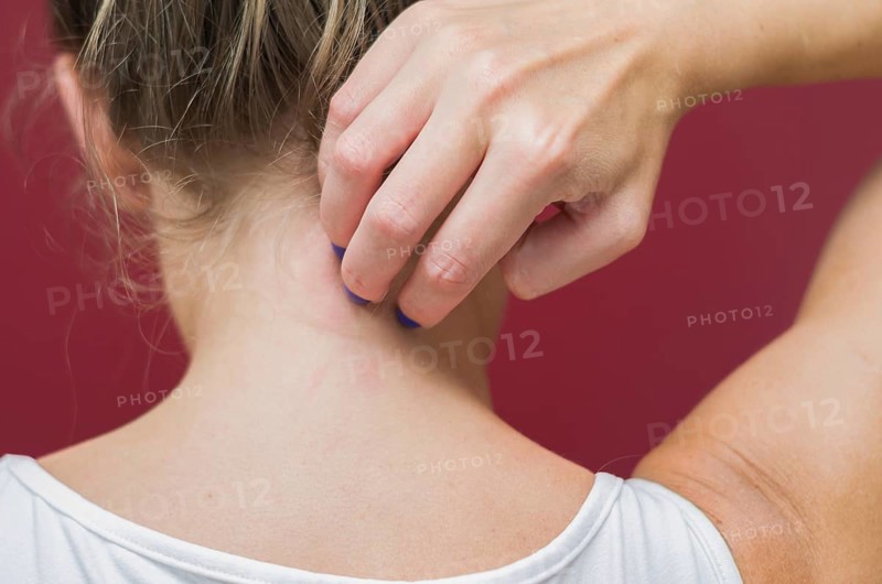 Great concept of allergy and skin diseases, young woman scratching herself