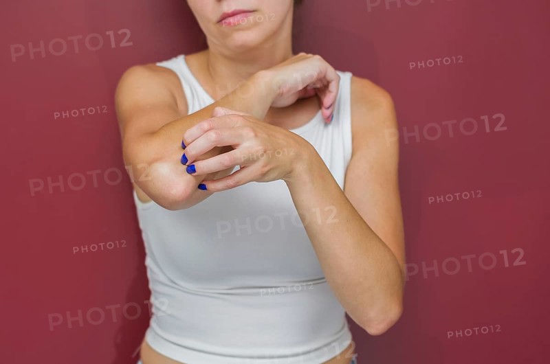 Great concept of allergy and skin diseases, young woman scratching herself