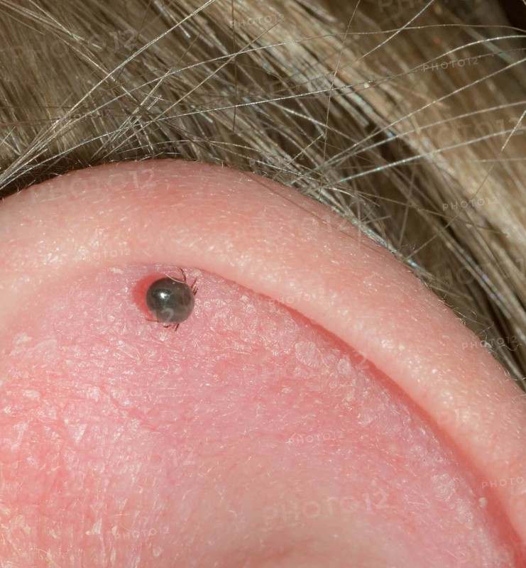 Fully sucked castor bean tick (Ixodes ricinus), tick in the developmental stage nymph sucking on human skin on the ear of a blond child, macro photograph, close-up, Lower Saxony, Germany, Europe