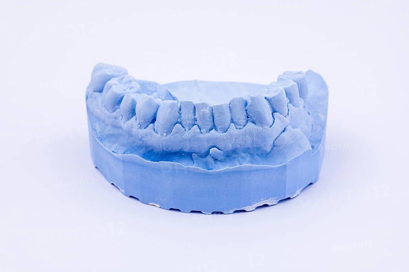 Denture impression of an upper jaw for dentures, dentist, dental impression