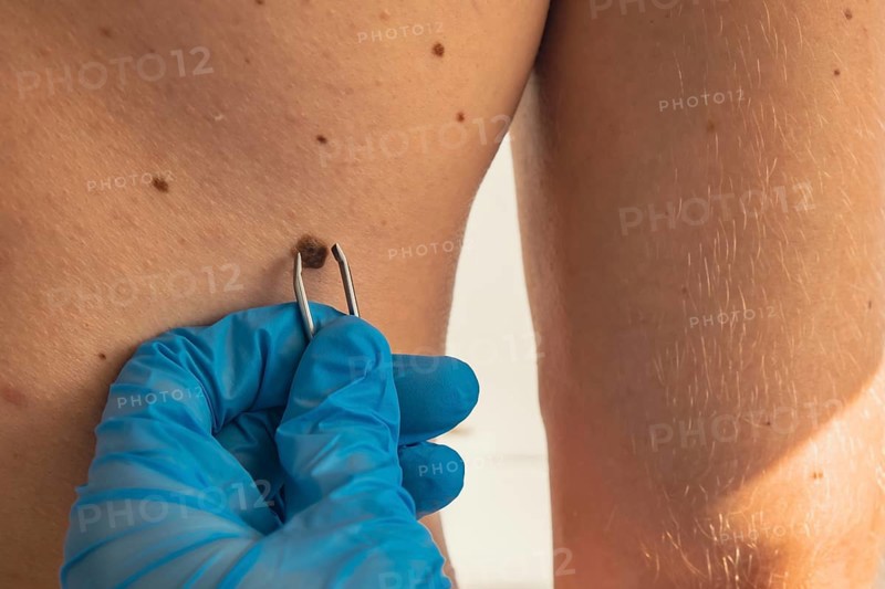 Doctor in medical gloves examining man skin mole for size. Dermatologist checking male birthmarks. Self care preventing cancer procedure. Protection treatment. Imperfection skin positivity