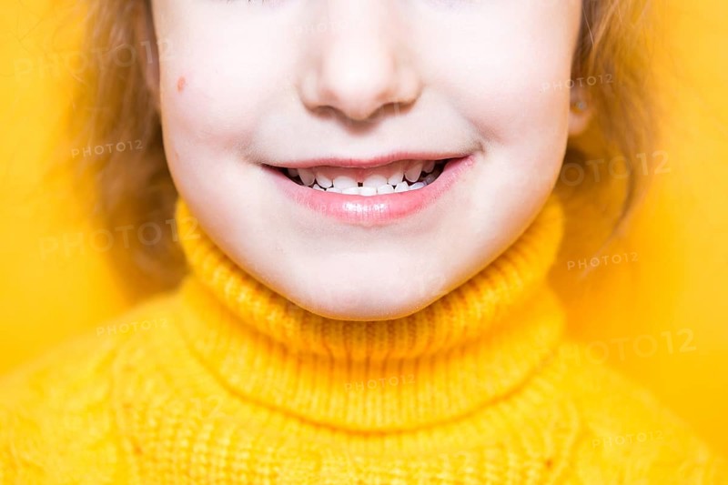 Girl shows her teeth-pathological bite, malocclusion, overbite. Pediatric dentistry and periodontics, bite correction. Health and care of teeth, caries treatment, baby teeth. Upper jaw rests on gum