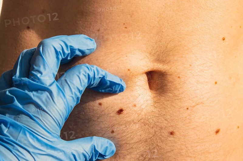 Dermatologist checking male birthmarks. Doctor in medical gloves examining man skin mole. Self care preventing cancer procedure. Protection treatment. Imperfection skin positivity