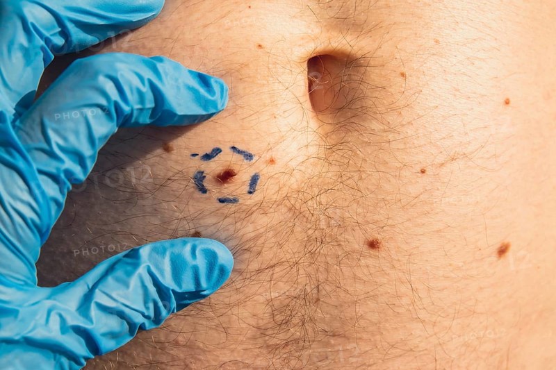 Doctor in medical gloves paint lines around male birthmarks. Preparing procedure for medical surgery. Laser skin tags removal. Prevention of melanoma and nevus exam