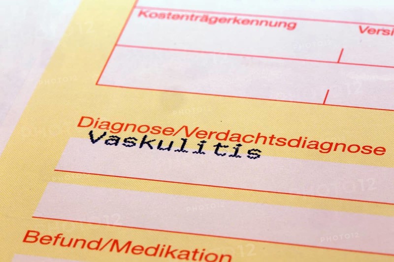 Symbolic image: Diagnosis of vasculitis on a doctor's referral. Vasculitis often occurs after corona infections, but is also one of the side effects of a corona vaccination