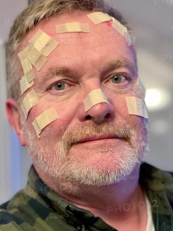 Man with many small wound patches on his face, after a laser treatment at the dermatologist, for basal cell carcinoma, white skin cancer, suspicious skin areas were removed and are being examined and the damaged skin areas removed with a laser, outpatient procedure