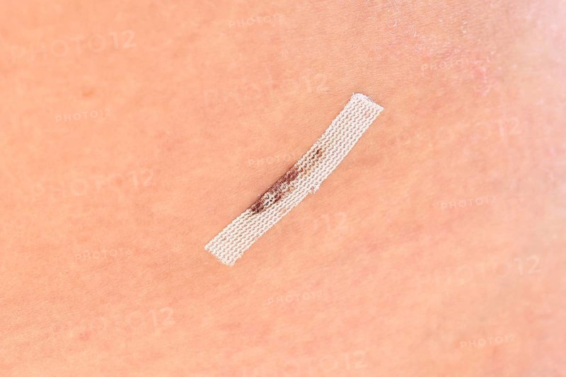 Close up of sterile wound closure strip used on cut after laparoscopy on woman's lower abdomen