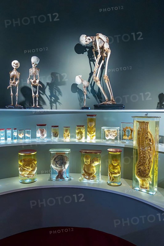 Anatomical collection, specimens, wet preparation. Skeleton, human, deformity, research, medicine, exhibition, museum, inside, interior, University Museum, Groningen, Netherlands