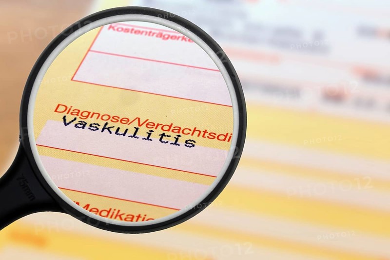Symbolic image: Diagnosis of vasculitis on a doctor's referral. Vasculitis often occurs after corona infections, but is also one of the side effects of a corona vaccination