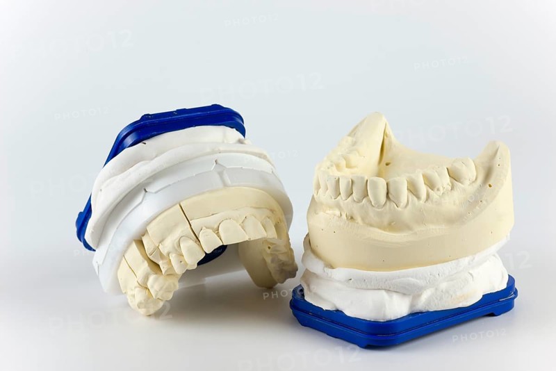 Two dental plaster casts with a blue border on a white background, representing the upper and lower row of teeth, impression for the fabrication of a partial crown