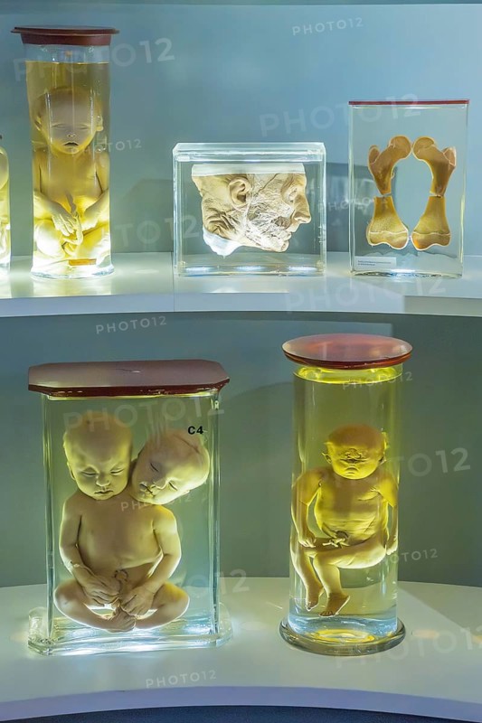 Anatomical collection, specimens, wet preparation. Skeleton, human, deformity, research, medicine, exhibition, museum, inside, interior, University Museum, Groningen, Netherlands