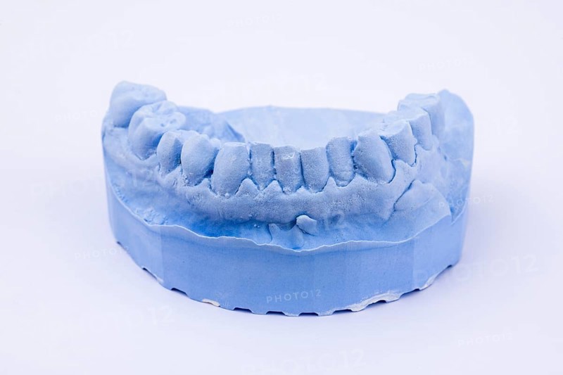 Denture impression of an upper jaw for dentures, dentist, dental impression