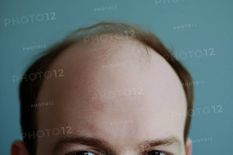 Close up of balding forehead of a middle aged man in front of blue background. Generative AI, AI generated