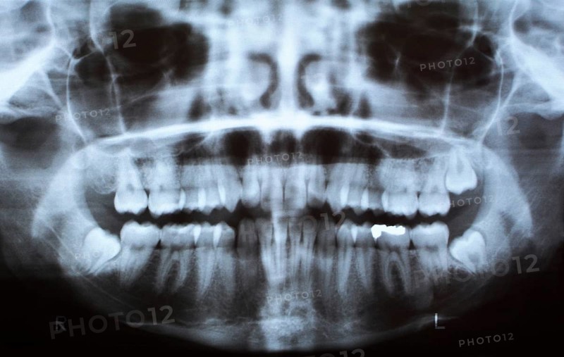 Dental X-Ray from a mouth with one tooth filling and a three intact wisdom teeth