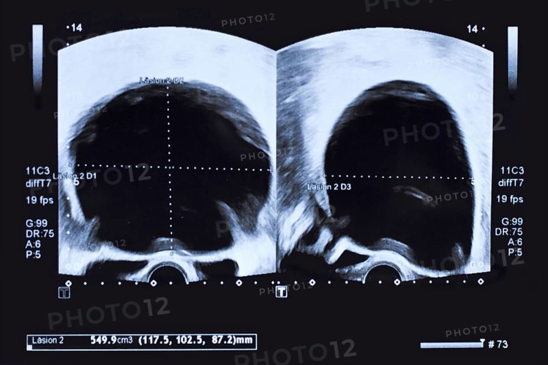 Ultrasound image of large round cyst in lower abdomen of woman printed on a piece of paper
