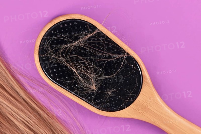 Concept for losing hair with strands of blond hair caught in hair brush