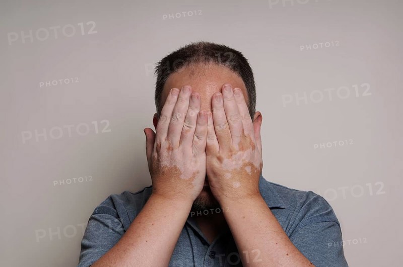 man affected by Vitiligo skin condition hiding his face