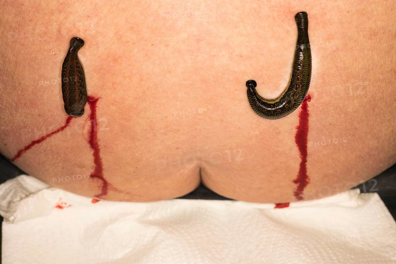 Two medicinal leeches (Hirudo medicinalis) were applied to the left and right of the spine, blood running down the buttocks