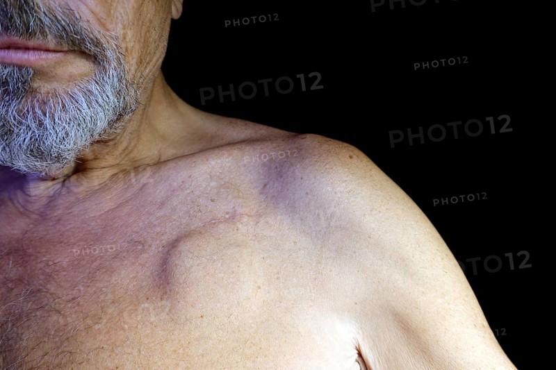 Elderly man with a pacemaker, studio photography with black background