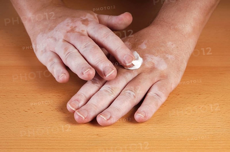 Vitiligo or white spot disease
